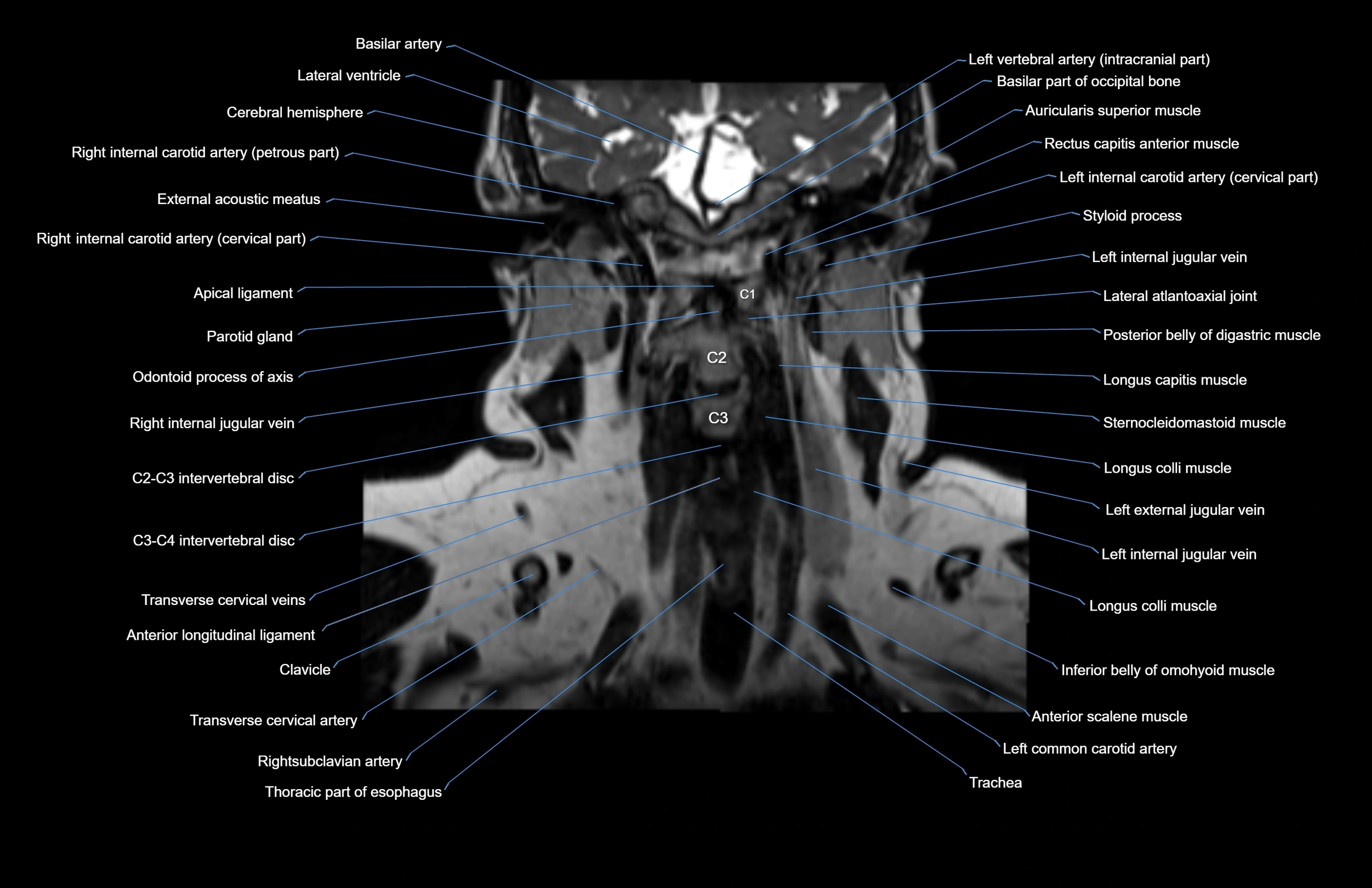 Neck coronal cross sectional MRI anatomy 3T MRI  image-img-00001-00034.webp